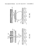 Methods and Devices to Treat Obesity diagram and image