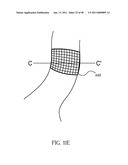 Methods and Devices to Treat Obesity diagram and image