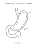 Methods and Devices to Treat Obesity diagram and image