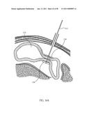 Methods and Devices to Treat Obesity diagram and image