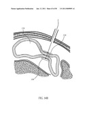 Methods and Devices to Treat Obesity diagram and image