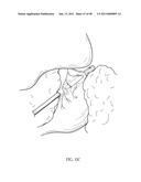 Methods and Devices to Treat Obesity diagram and image