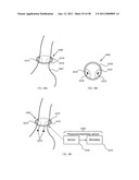 Methods and Devices to Treat Obesity diagram and image