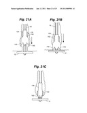 METAL VASCULAR APERTURE CLOSURE DEVICE diagram and image