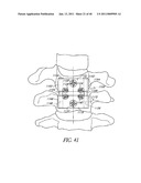 METHODS AND APPARATUSES FOR STABILIZING THE SPINE THROUGH AN ACCESS DEVICE diagram and image