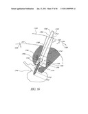 METHODS AND APPARATUSES FOR STABILIZING THE SPINE THROUGH AN ACCESS DEVICE diagram and image