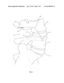 TRANS-PEDICULAR INTERBODY FUSION diagram and image