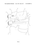 TRANS-PEDICULAR INTERBODY FUSION diagram and image