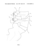 TRANS-PEDICULAR INTERBODY FUSION diagram and image