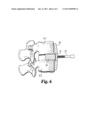 ORTHOPEDIC SUPPORT LOCATING OR CENTERING FEATURE AND METHOD diagram and image