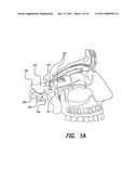 SKULL-MOUNTED ELECTRICAL STIMULATION SYSTEM AND METHOD FOR TREATING PATIENTS diagram and image