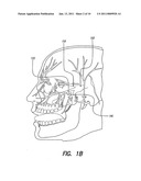 SKULL-MOUNTED ELECTRICAL STIMULATION SYSTEM AND METHOD FOR TREATING PATIENTS diagram and image