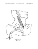 Reinforced Suture Sleeve diagram and image