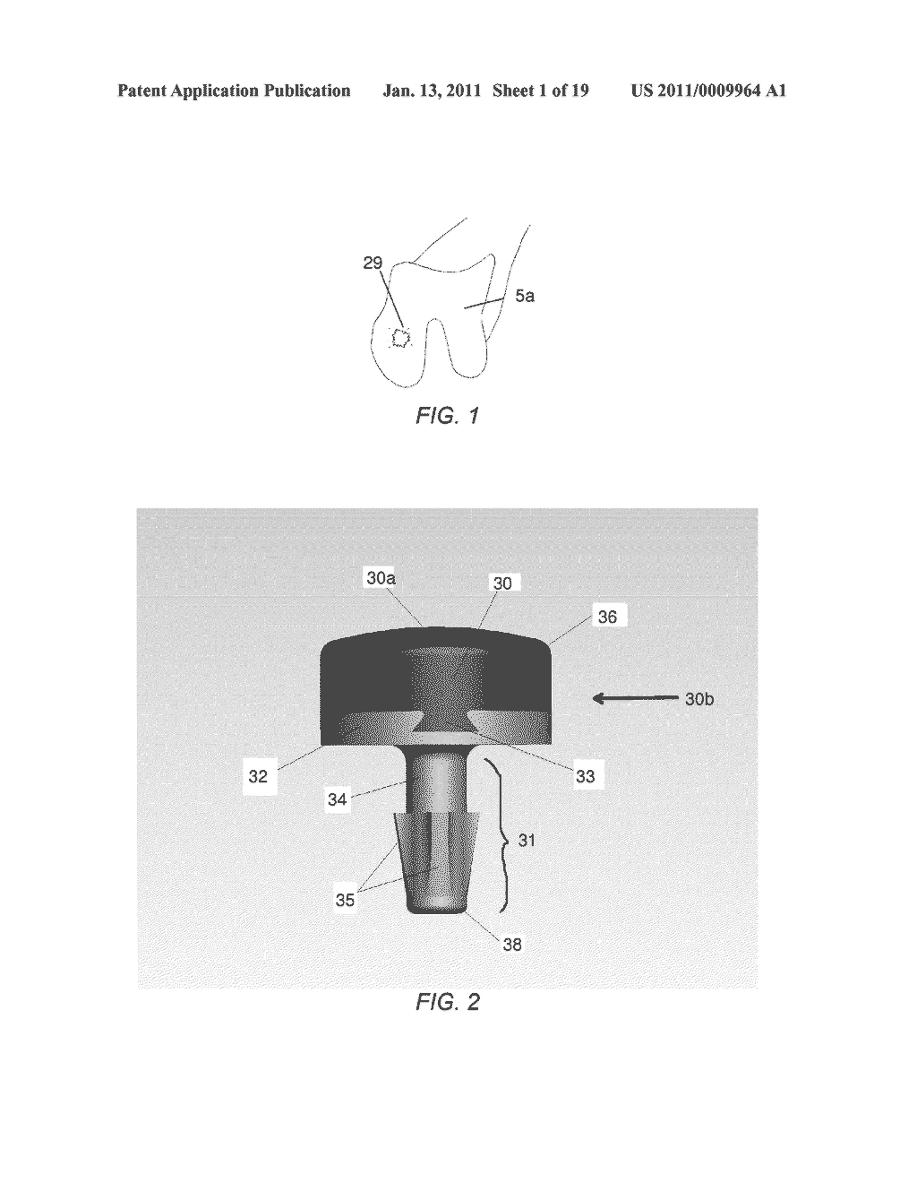 PARTIAL JOINT RESURFACING IMPLANT, INSTRUMENTATION AND METHOD - diagram, schematic, and image 02