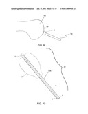 PARTIAL JOINT RESURFACING IMPLANT, INSTRUMENTATION AND METHOD diagram and image