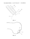 PARTIAL JOINT RESURFACING IMPLANT, INSTRUMENTATION AND METHOD diagram and image