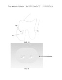 PARTIAL JOINT RESURFACING IMPLANT, INSTRUMENTATION AND METHOD diagram and image