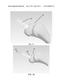PARTIAL JOINT RESURFACING IMPLANT, INSTRUMENTATION AND METHOD diagram and image