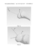 PARTIAL JOINT RESURFACING IMPLANT, INSTRUMENTATION AND METHOD diagram and image