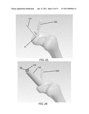 PARTIAL JOINT RESURFACING IMPLANT, INSTRUMENTATION AND METHOD diagram and image