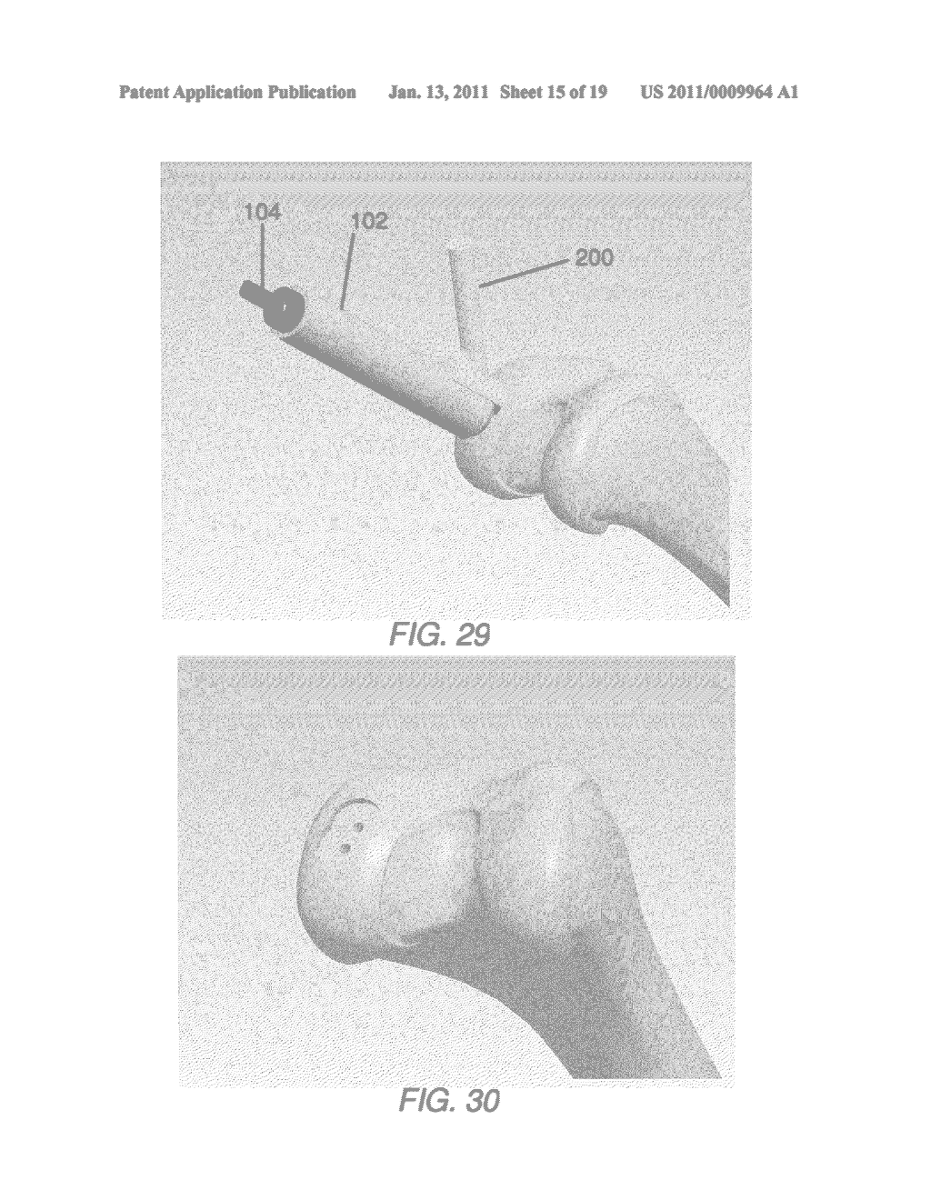 PARTIAL JOINT RESURFACING IMPLANT, INSTRUMENTATION AND METHOD - diagram, schematic, and image 16