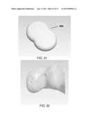 PARTIAL JOINT RESURFACING IMPLANT, INSTRUMENTATION AND METHOD diagram and image