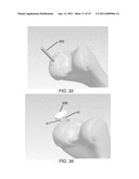 PARTIAL JOINT RESURFACING IMPLANT, INSTRUMENTATION AND METHOD diagram and image