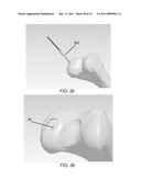 PARTIAL JOINT RESURFACING IMPLANT, INSTRUMENTATION AND METHOD diagram and image