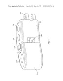 Inter-Body Implantation System and Method diagram and image