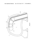 Inter-Body Implantation System and Method diagram and image