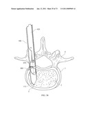 Inter-Body Implantation System and Method diagram and image