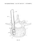 Inter-Body Implantation System and Method diagram and image