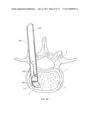 Inter-Body Implantation System and Method diagram and image