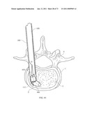 Inter-Body Implantation System and Method diagram and image