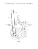 Inter-Body Implantation System and Method diagram and image