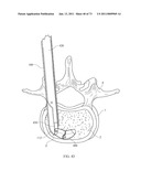 Inter-Body Implantation System and Method diagram and image
