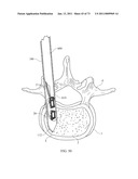 Inter-Body Implantation System and Method diagram and image