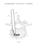 Inter-Body Implantation System and Method diagram and image