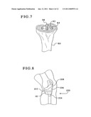 TIBIAL AUGMENTS FOR USE WITH KNEE JOINT PROSTHESES, METHOD OF IMPLANTING THE TIBIAL AUGMENT, AND ASSOCIATED TOOLS diagram and image