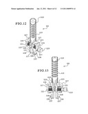 TIBIAL AUGMENTS FOR USE WITH KNEE JOINT PROSTHESES, METHOD OF IMPLANTING THE TIBIAL AUGMENT, AND ASSOCIATED TOOLS diagram and image