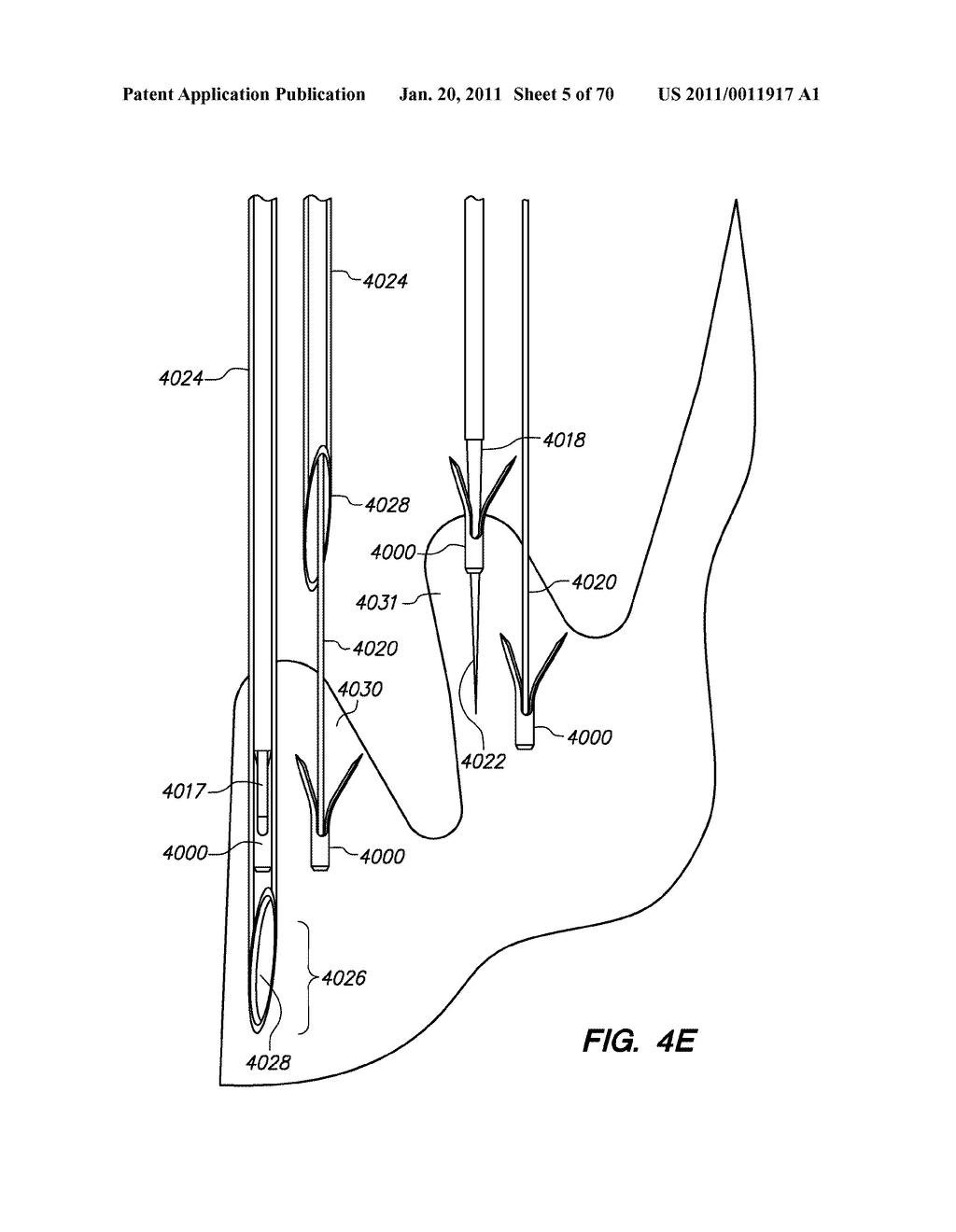 METHODS, DEVICES, AND KITS FOR TREATING VALVE PROLAPSE - diagram, schematic, and image 06