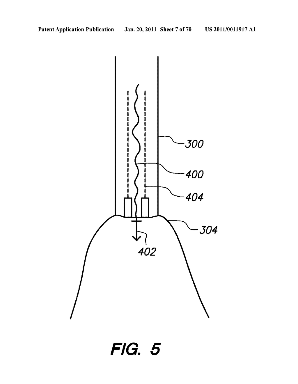 METHODS, DEVICES, AND KITS FOR TREATING VALVE PROLAPSE - diagram, schematic, and image 08