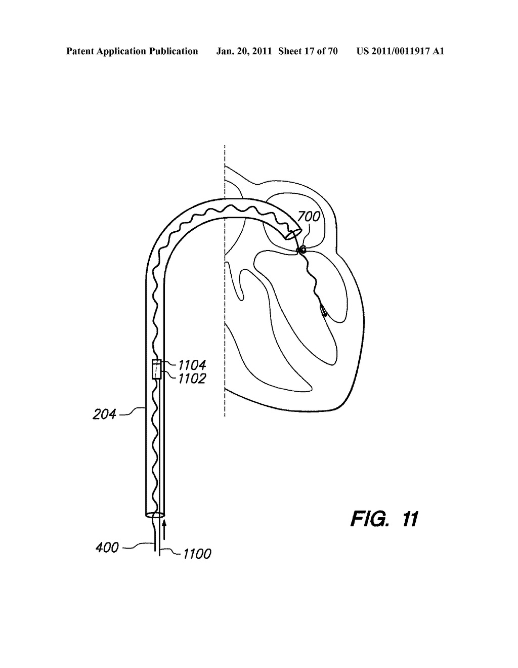 METHODS, DEVICES, AND KITS FOR TREATING VALVE PROLAPSE - diagram, schematic, and image 18