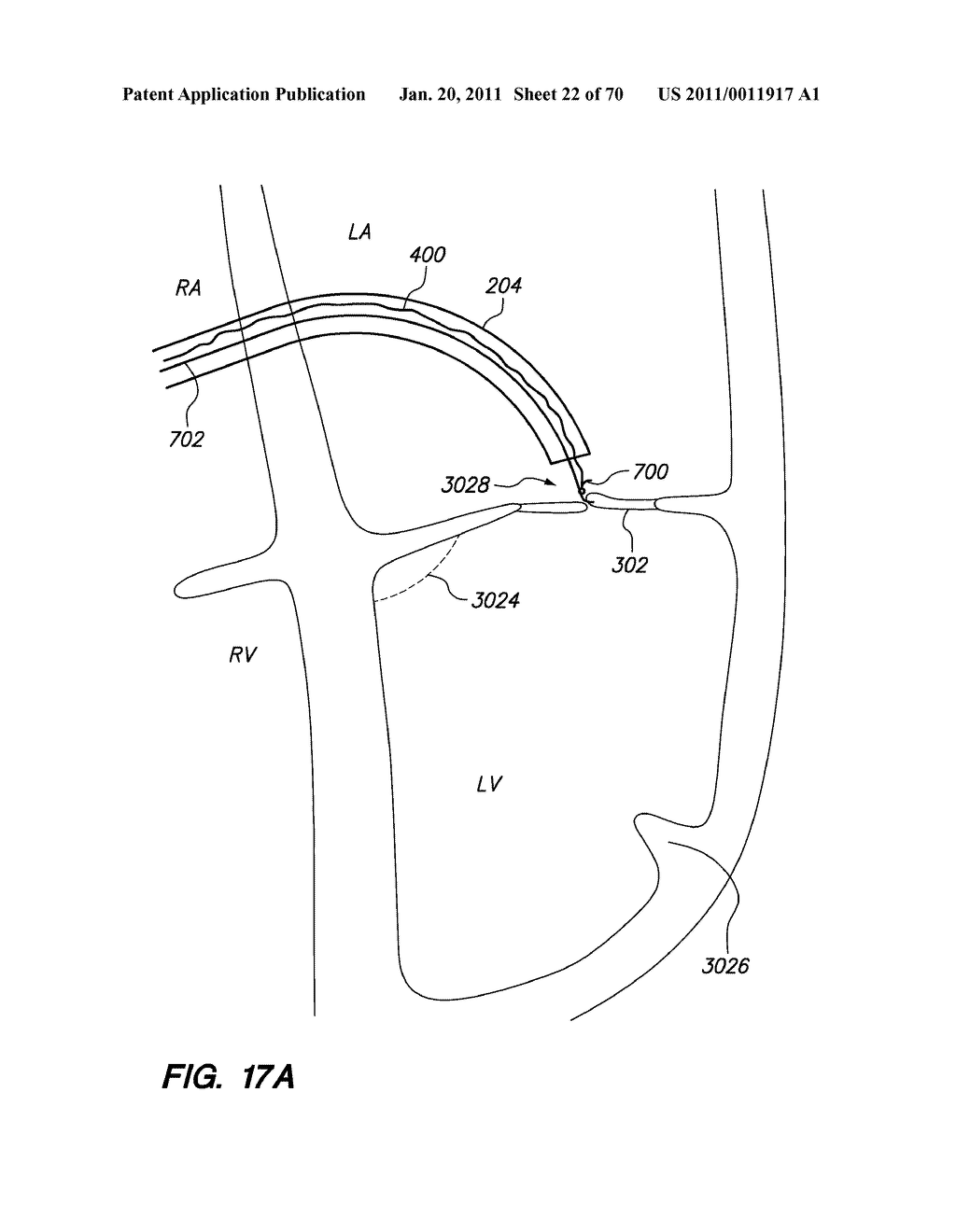 METHODS, DEVICES, AND KITS FOR TREATING VALVE PROLAPSE - diagram, schematic, and image 23