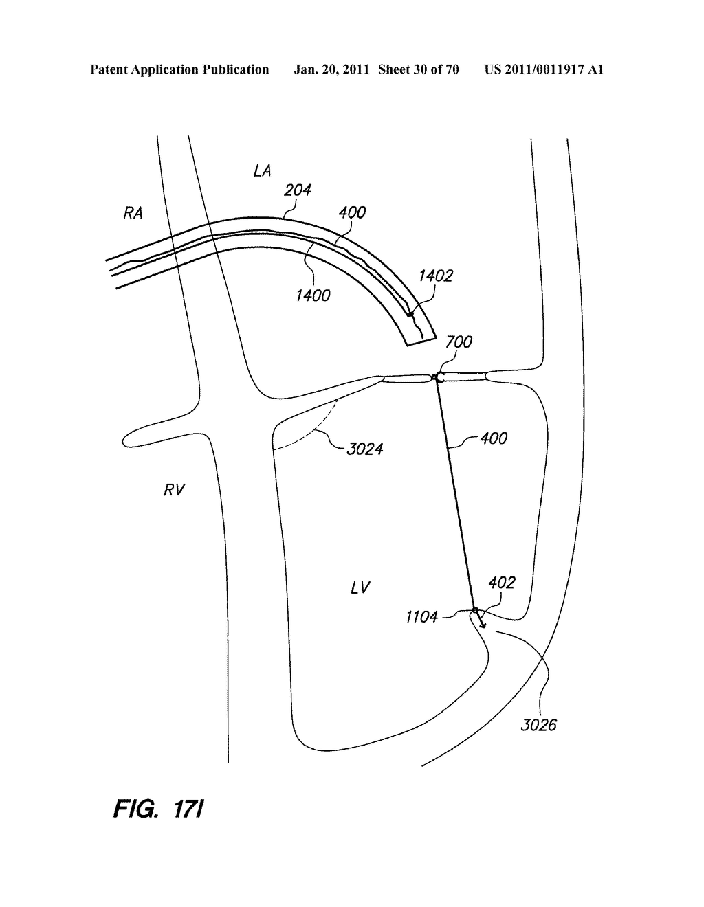 METHODS, DEVICES, AND KITS FOR TREATING VALVE PROLAPSE - diagram, schematic, and image 31