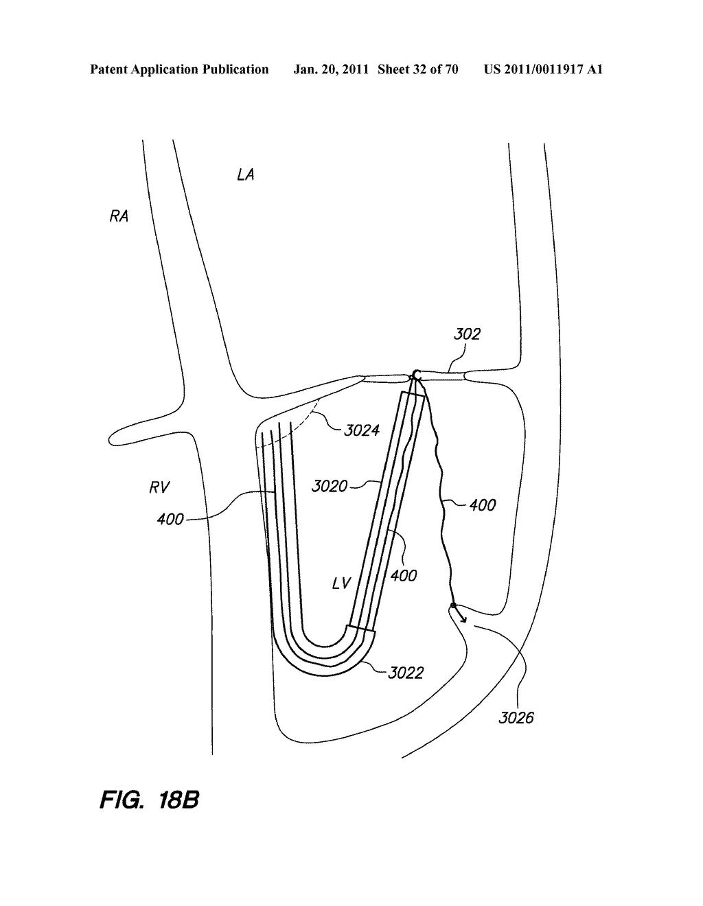 METHODS, DEVICES, AND KITS FOR TREATING VALVE PROLAPSE - diagram, schematic, and image 33