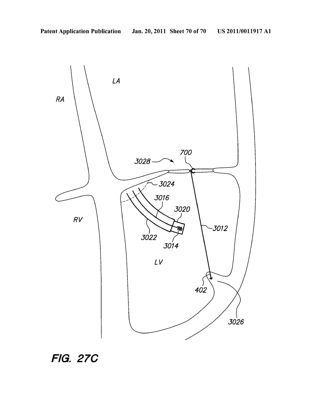 METHODS, DEVICES, AND KITS FOR TREATING VALVE PROLAPSE - diagram, schematic, and image 71