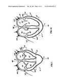 Delivery of cardiac constraint jacket diagram and image