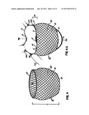 Delivery of cardiac constraint jacket diagram and image