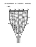 Delivery of cardiac constraint jacket diagram and image